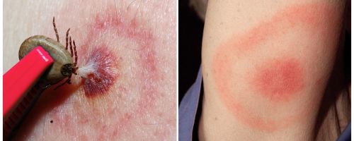 Vad är Lyme sjukdom, dess symptom, behandling och foto