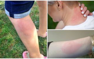 Behandling av allergier mot myggbett hos vuxna och barn