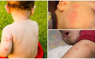 Fonder för barn efter myggbett