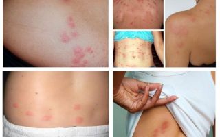 Vad ser bedbugs biter ut på människans hud?