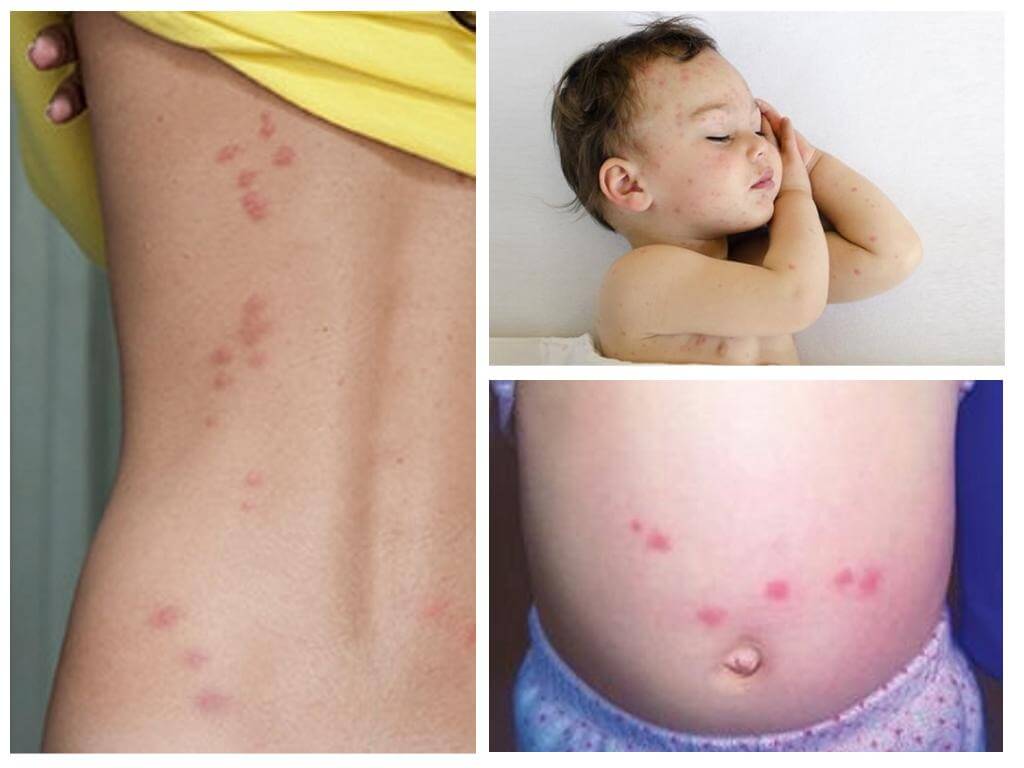 Bedbugs bita kvinnor och barn