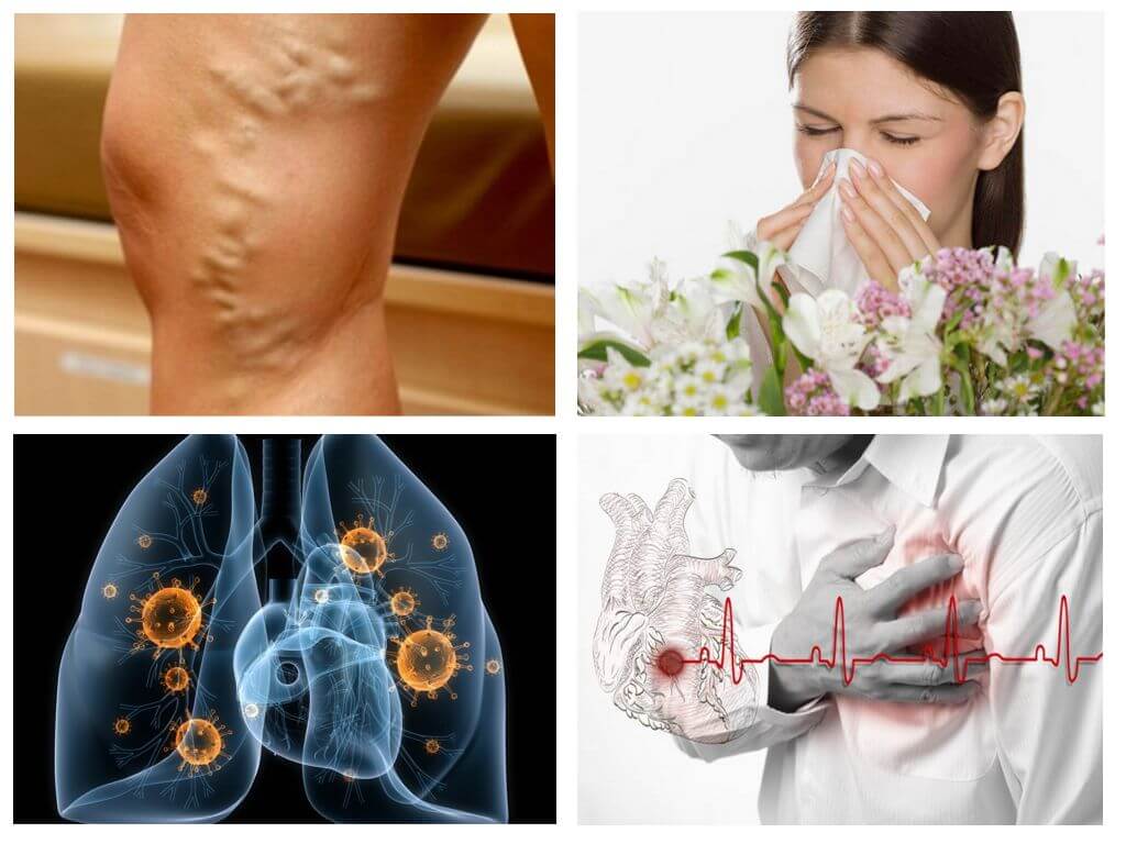 Allergi, hjärtsjukdom, tuberkulos