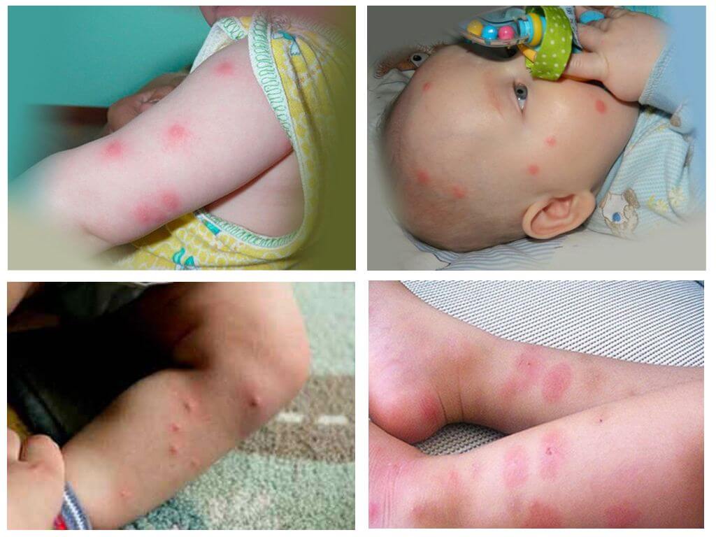 Flea bites i ett barn