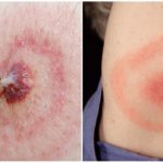 Lyme Disease eller Tick-borne Borreliosis